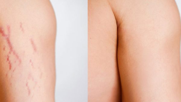 Best Stretch Mark Removal Creams 2021: The lotion that Removes & Prevention Stretch marks