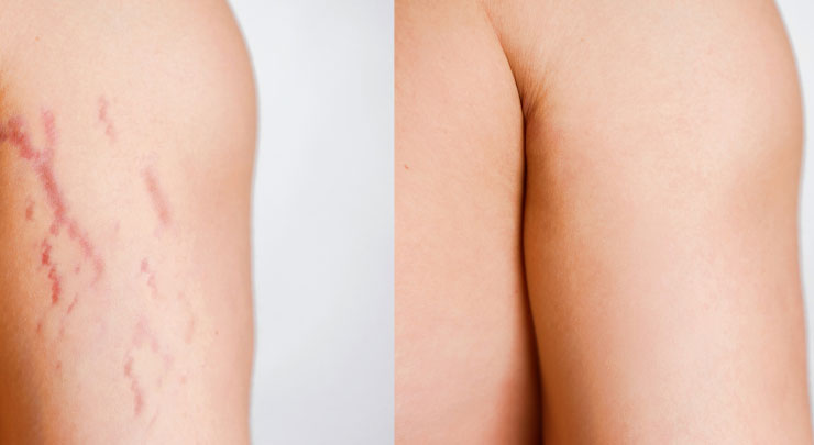Best Stretch Mark Removal Creams 2021: The lotion that Removes & Prevention Stretch marks